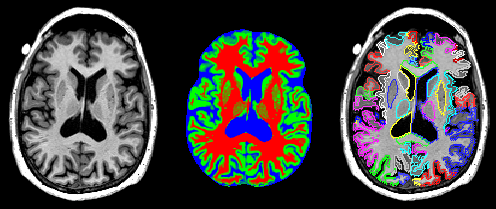 Brain segmentation with MAPER